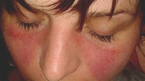 Lupus Rash Vs Rosacea Symptoms Causes Treatments