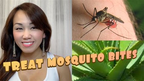 Treat Mosquito Bites Youtube