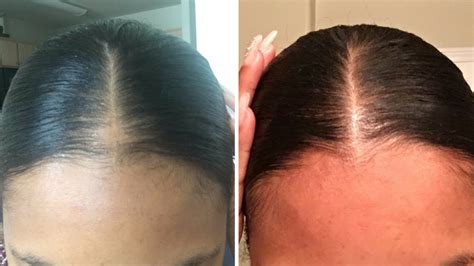27 How To Make Hair Grow Faster On Bald Spot