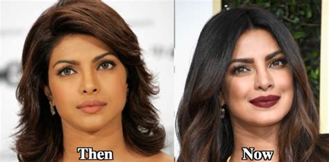 Priyanka Chopra Plastic Surgery Before And After Photos
