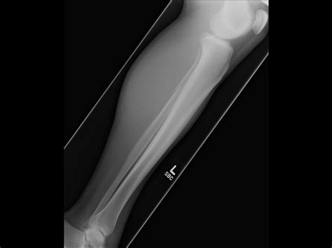Fibula Fracture With Ankle Swelling Clinical Pain Advisor