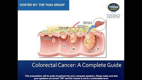 Colorectal Cancer A Complete Guide Youtube