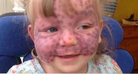 Daughter Is Born With Rare Birthmark On Her Face But Then Doctors Tell