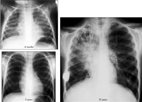 Chest Radiographs In A Child Showing The Serial Changes Of Cystic