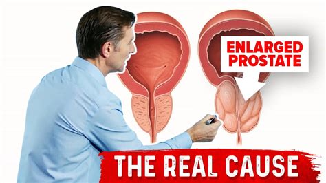 Enlarged Prostate And Urination Problems Explained