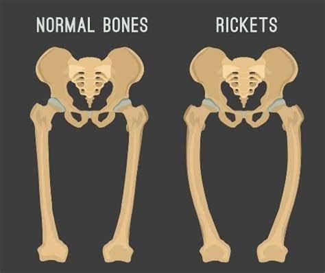 Causes Of Rickets Medizzy