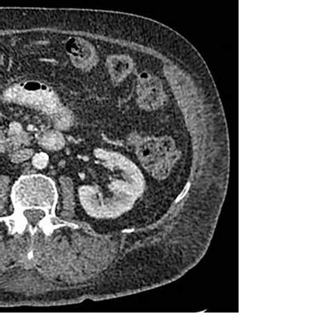 Computed Tomography Image Of The Abdomen With Oral And Intravenous