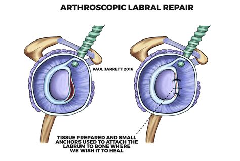 Instability And Dislocations Dr Paul Jarrett Orthopaedic Surgeon Perth
