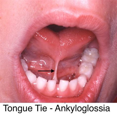 Tongue Tie And Lip Tie Frenectomy Frisco Kids Dentistry