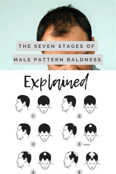 7 Stages Of Male Pattern Baldness Explained Male Baldness Cool