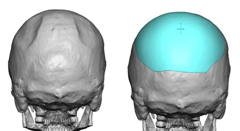 Custom Occipital Skull Implant Design For Indentations Back View Dr