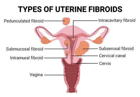 Fibroid Degeneration Vein Endovascular Medical Care