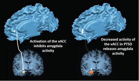 Revisiting The Role Of The Amygdala In Posttraumatic Stress Disorder
