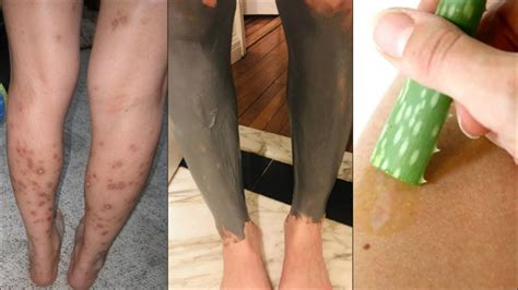 Bentonite Clay And Aloe Vera Treatment Get Rid Of Dark Marks And Scars On