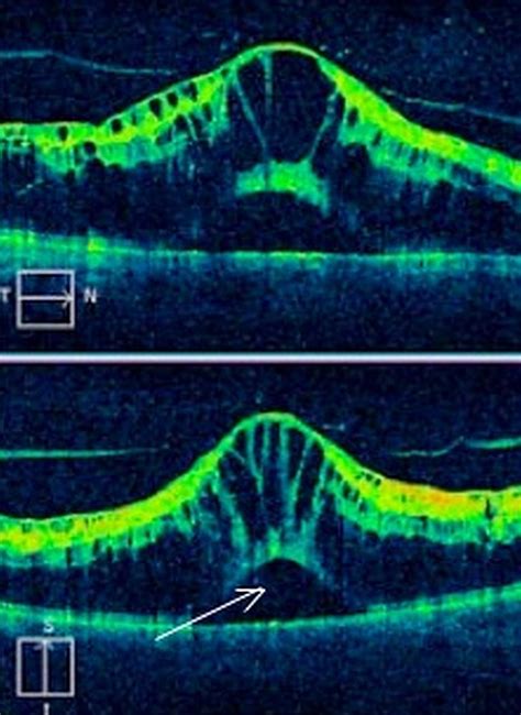 Optical Coherence Tomography Imaging Of Macular Oedema British