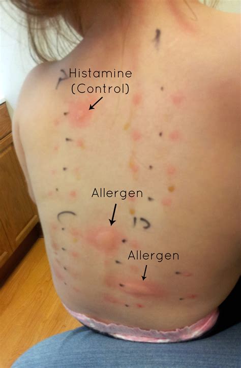 Skin Allergy Test Nutrition Mission