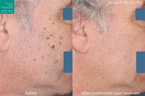 Sun Damage And Brown Spot Removal San Diego Ca Clderm