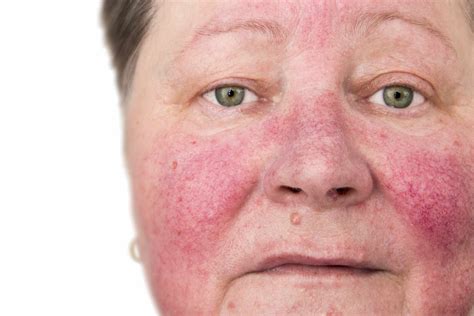 Papier Tumeur Maligne Compétitif Red Spots On Face A Gagné Tempérer Bande De Roulement