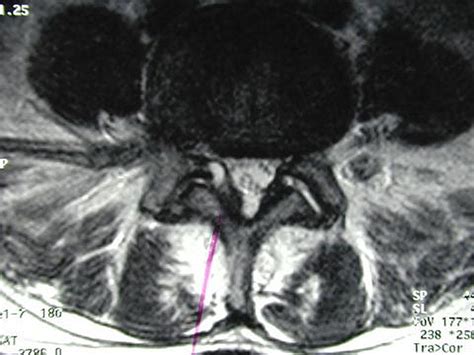 Spinal Lumbar Synovial Cysts Diagnosis And Management Challenge
