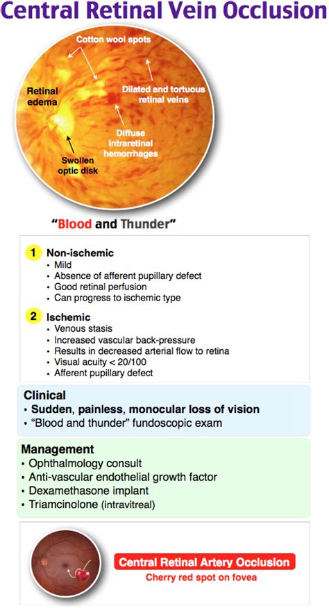 Central Retinal Vein Occlusion Optometry Education Eye Health