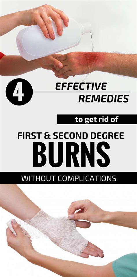 4 Effective Remedies To Get Rid Of First And Second Degree Burns