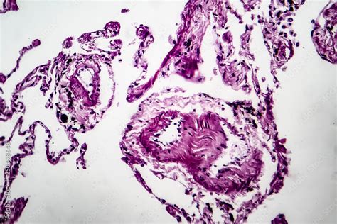 Histopathology Of Lung Emphysema Light Micrograph Photo Under