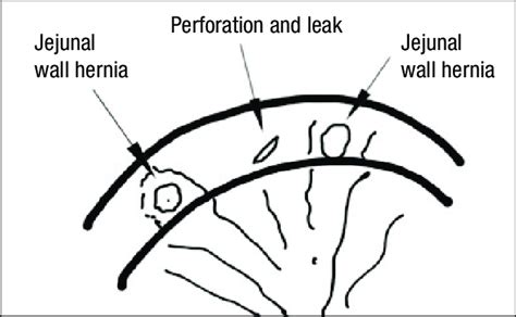 Small Intestine Wall Hernias Download Scientific Diagram