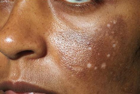 Hyperpigmentation is the darkening of the skin caused by increased melanin. Hyperpigmentation: How to Properly Treat and Prevent It ...