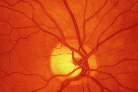 Healthy Retina Of Eye Photograph By Steve Allenscience Photo Library