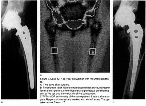 Distribution Of Radiolucent Lines Around The Femoral Component