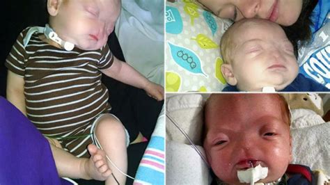 Pic Baby Born Without Nose Eli Thompson Suffers From Rare