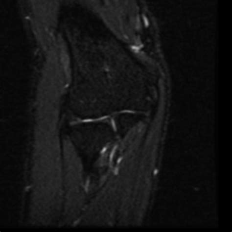 Ulnar Nerve Entrapment Syndrome In Cubitus Valgus Radiology Case