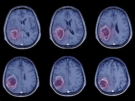 Premium Photo Ct Scan Brain Imaging For Hemorrhagic Stroke Or