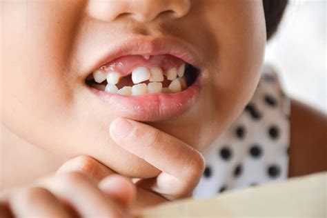 Dental Injuries In Children Part 1 Schubbs Dental
