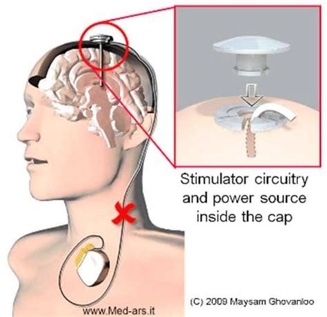 Pin On Deep Brain Stimulation DBS