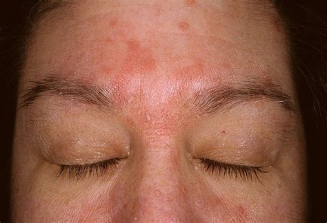 Dermatite seborréica causas sintomas e tratamentos Pele Problemas E