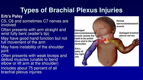 Brachial Plexus Injuries At Birth Plexus Products Brachial Erb Palsy