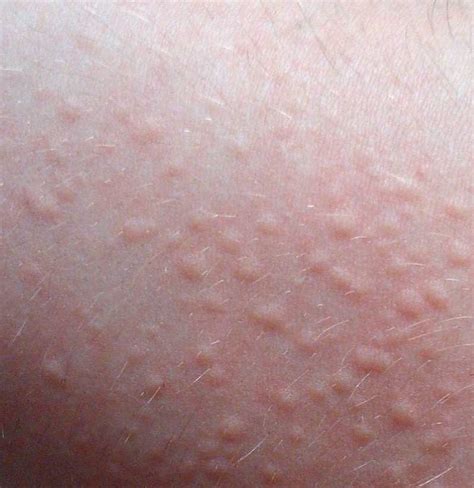 Urticaria Hives Definition Symptoms Diagnosis Treatme