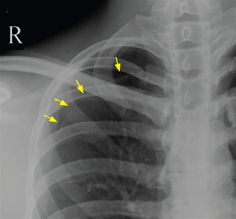 Apical Pneumothorax