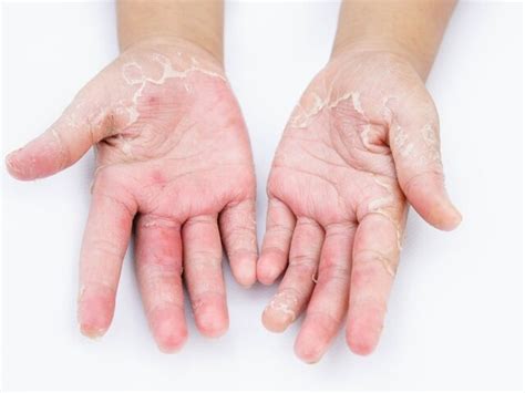 Grzybica dłoni objawy przyczyny i leczenie Zdrowie Wprost