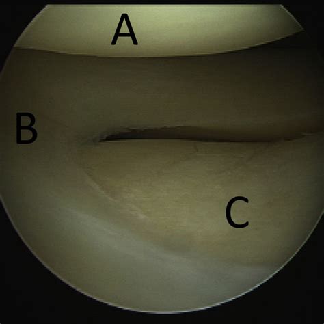 Arthroscopic View Of The Suprapatellar Pouch Of A Right Knee From The