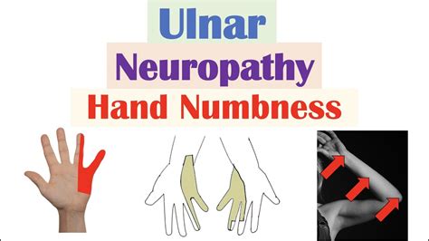 Ulnar Neuropathy And Numbness In The Hand Causes Signs And Symptoms