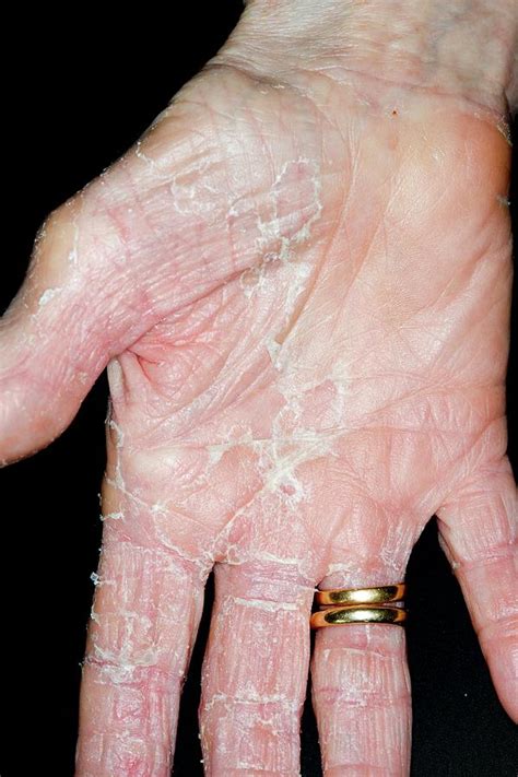 Exfoliative Dermatitis Of The Hand Photograph By Dr P Marazziscience Photo Library