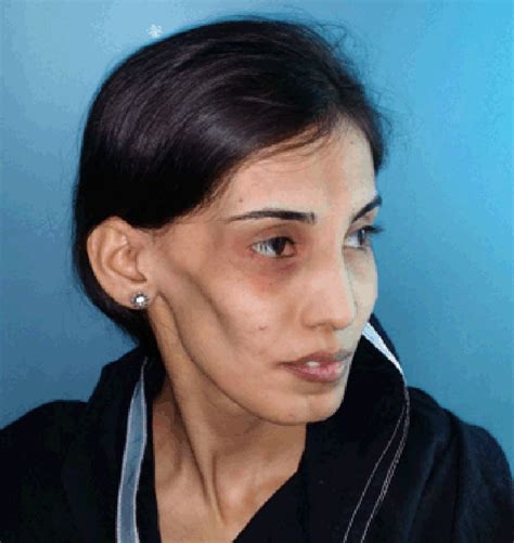 Right Sided Facial Atrophy Prominent Cheekbone Ipsilateral Hair Loss