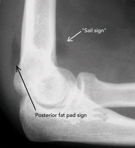 Posterior Fat Pad Sign Sail Sign Elevation Of The Anterior Fat Pad