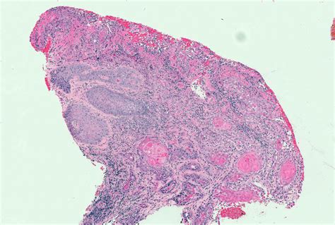 Pathology Outlines Squamous Cell Carcinoma Vulva