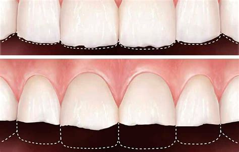 Desgaste Dental Causas Y Cómo Corregirlo Clínica Dental Provenza