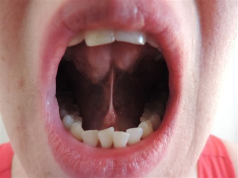 What Is A Tongue Tie — Integrated Therapies