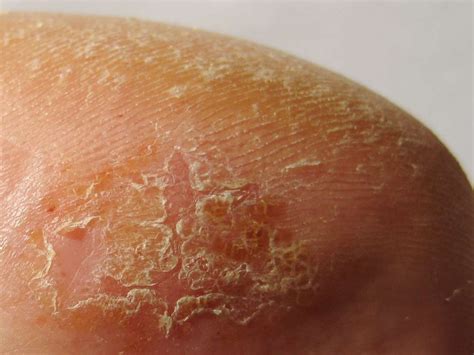 That extra barrier can help avoid infection (though nowhere near as well as pubic hair is not intrinsically unhygienic. White Flaky Skin In Pubic Area - toxoplasmosis