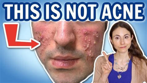 Breakout On The Face Not Acne 🤔 Dermatologist Drdrayzday Youtube